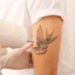 rimuovere tatuaggi