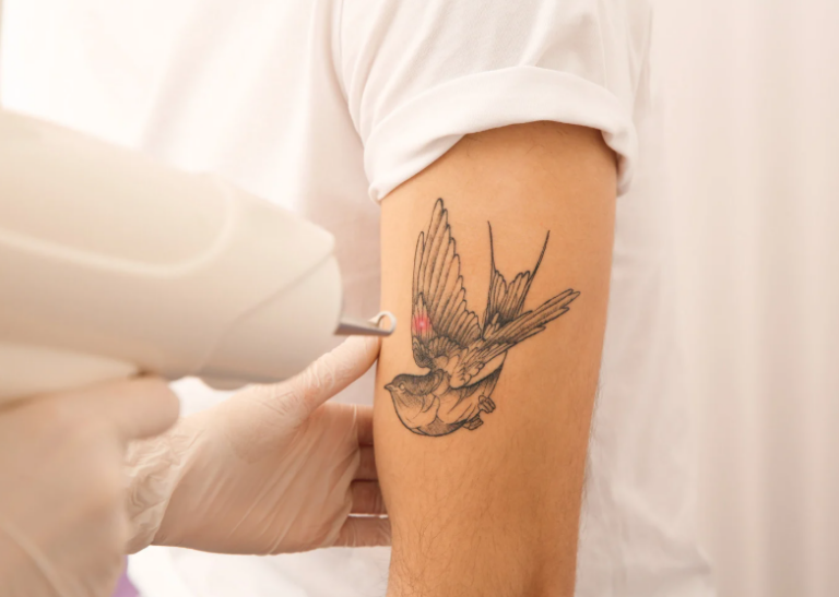 rimuovere tatuaggi